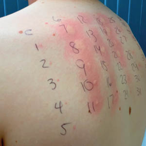 Allergy Testing in Sikar