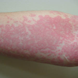 Urticaria treatment in Sikar